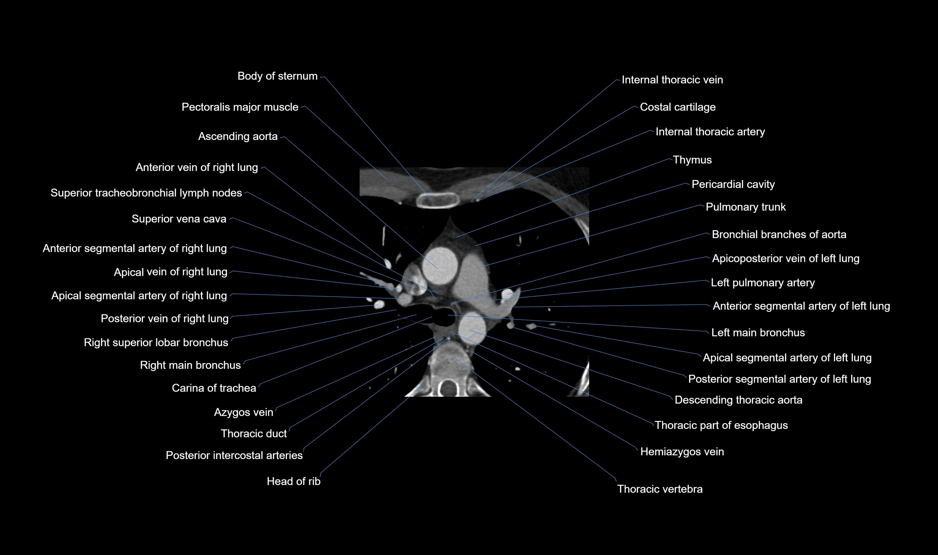 CT heart (coronary angiogram) axial view cross sectional anatomy labelled radiology image-00005.webp